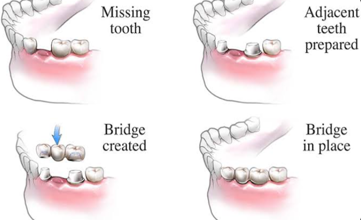 What May Be Involved in Getting a Dental Crown or Bridge: A General Overview What May Be Involved in Getting a Dental Crown or Bridge: A General Overview